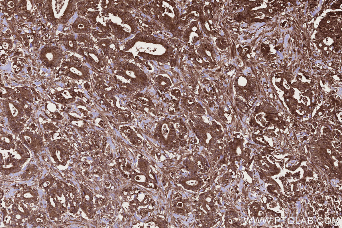 IHC staining of human rectal cancer using 13624-1-AP IHC staining of human rectal cancer using 13624-1-AP