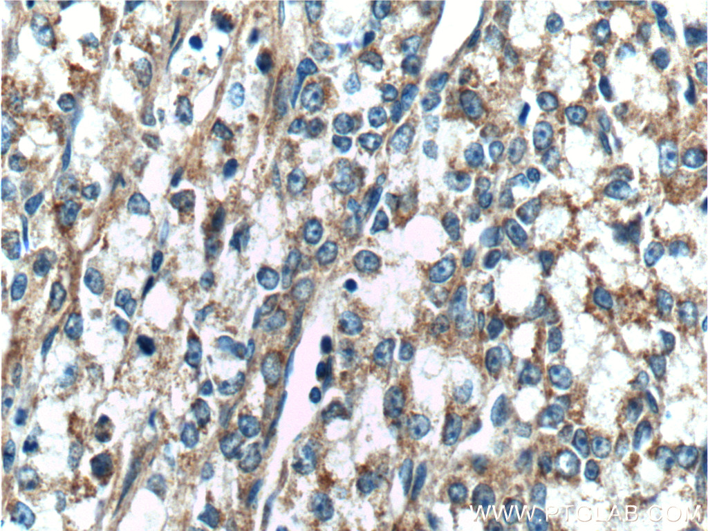 IHC staining of human prostate cancer using 11549-1-AP