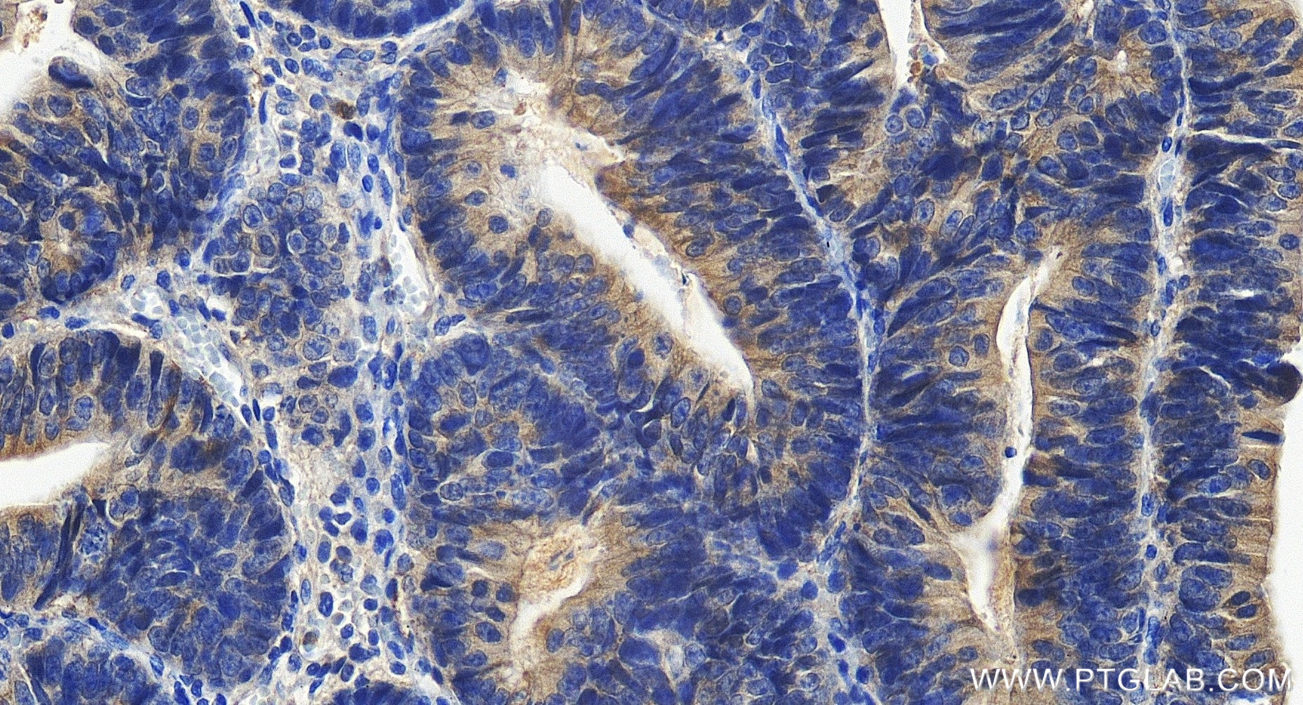Immunohistochemical analysis of paraffin-embedded human colon cancer tissue slide using 82720-14-RR (CAMKK2 antibody) at dilution of 1:800 (under 20x lens). Heat mediated antigen retrieval with Tris-EDTA buffer (pH 9.0). IHC staining of human colon cancer using 82720-14-RR