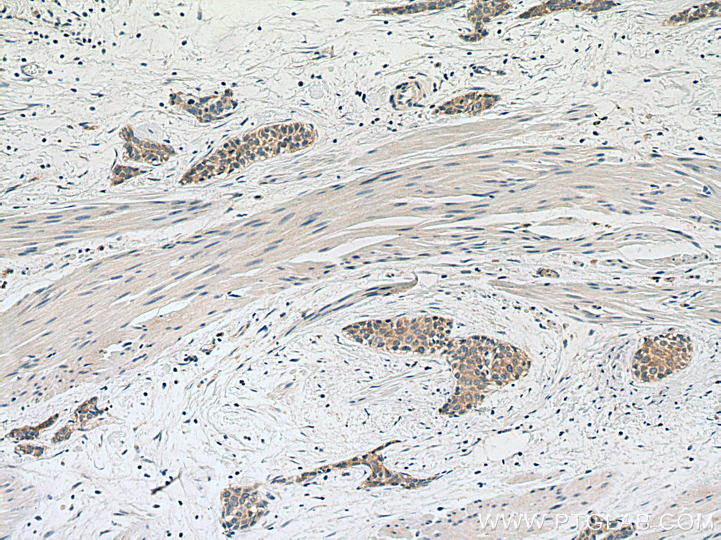 IHC staining of human urothelial carcinoma using 67732-1-Ig