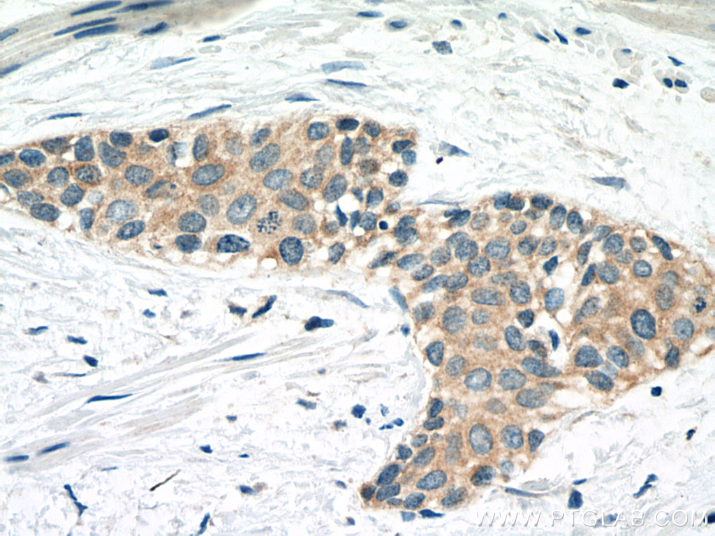 IHC staining of human urothelial carcinoma using 67732-1-Ig (same clone as 67732-1-PBS)