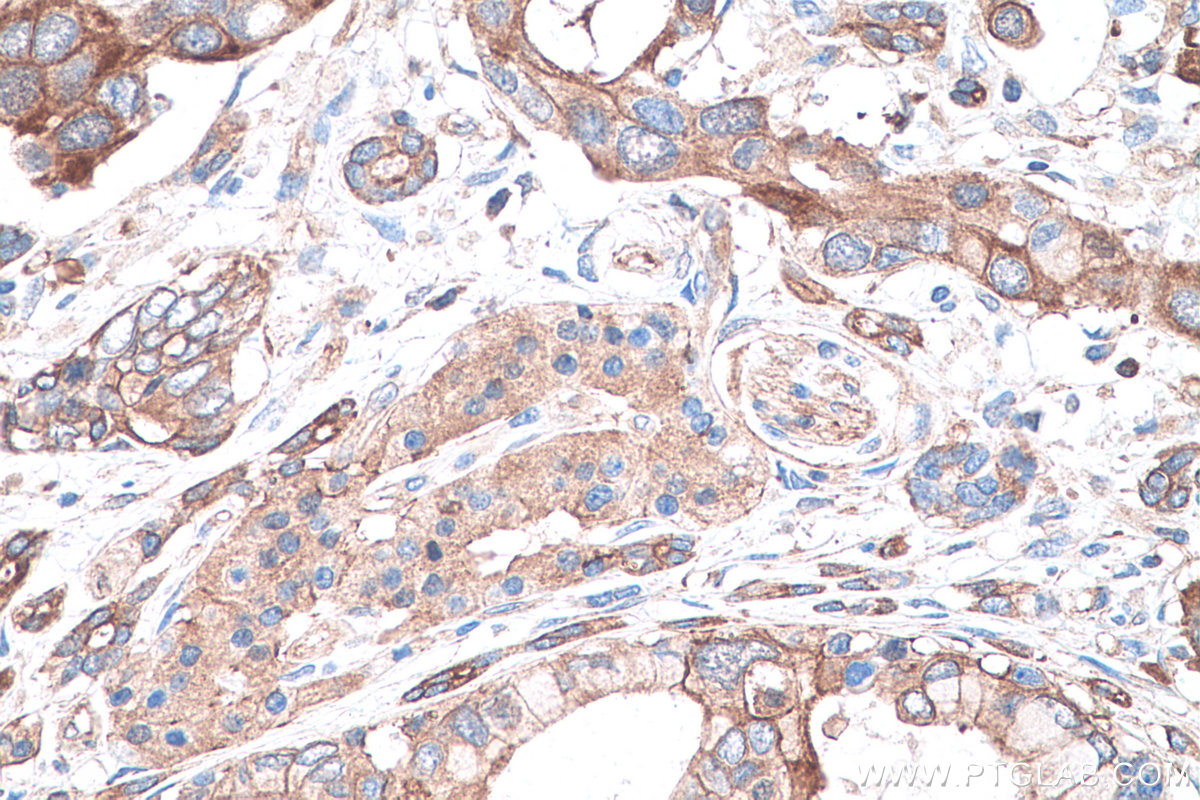 IHC staining of human pancreas cancer using 66977-1-Ig