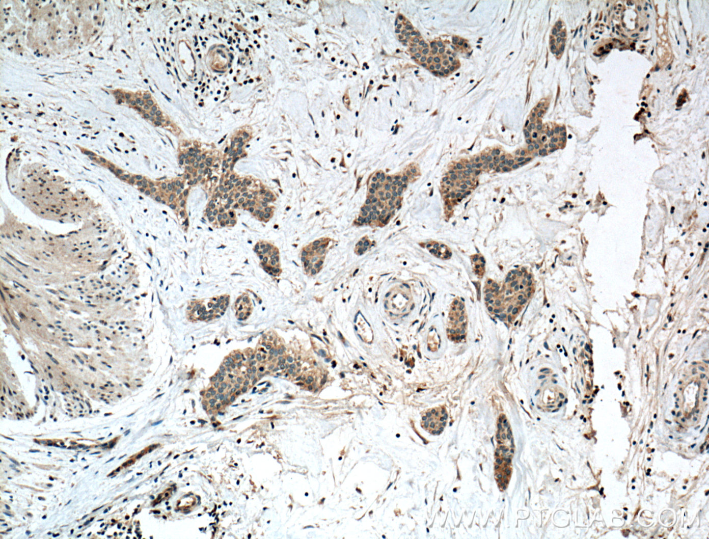 IHC staining of human urothelial carcinoma using 10415-1-AP