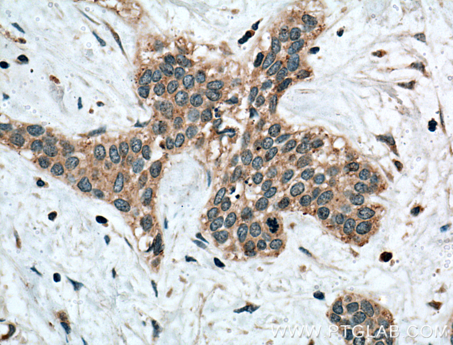 IHC staining of human urothelial carcinoma using 10415-1-AP