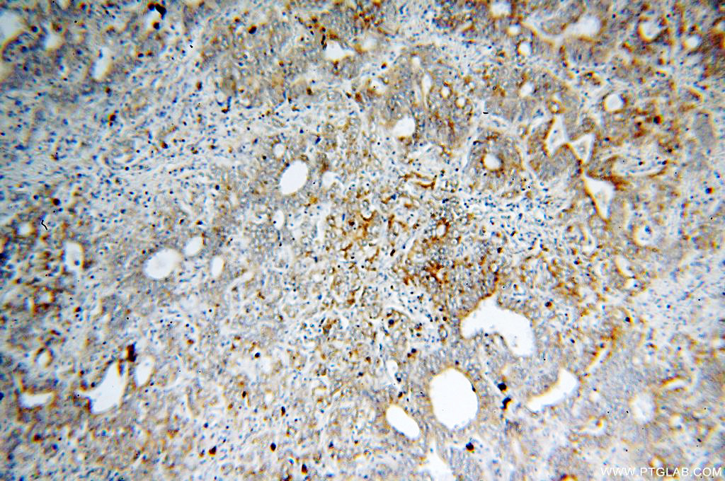 IHC staining of human stomach cancer using 17556-1-AP