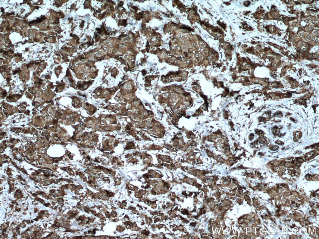 IHC staining of human breast cancer using 15112-1-AP