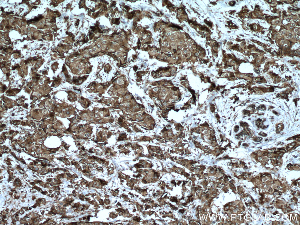 IHC staining of human breast cancer using 15112-1-AP