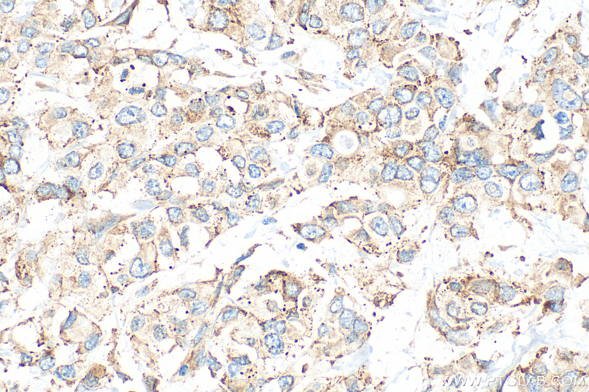 Immunohistochemical analysis of paraffin-embedded human breast cancer tissue slide using 15112-1-AP (CAPRIN1 antibody) at dilution of 1:1000 (under 40x lens). Heat mediated antigen retrieval with Tris-EDTA buffer (pH 9.0). IHC staining of human breast cancer using 15112-1-AP