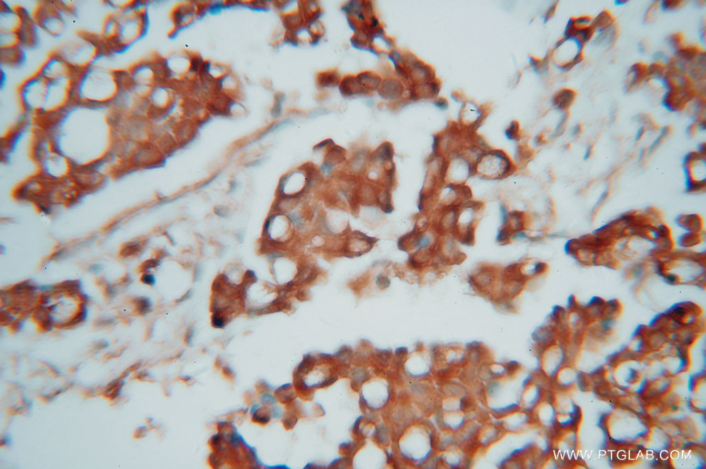 IHC staining of human ovary tumor using 11806-1-AP