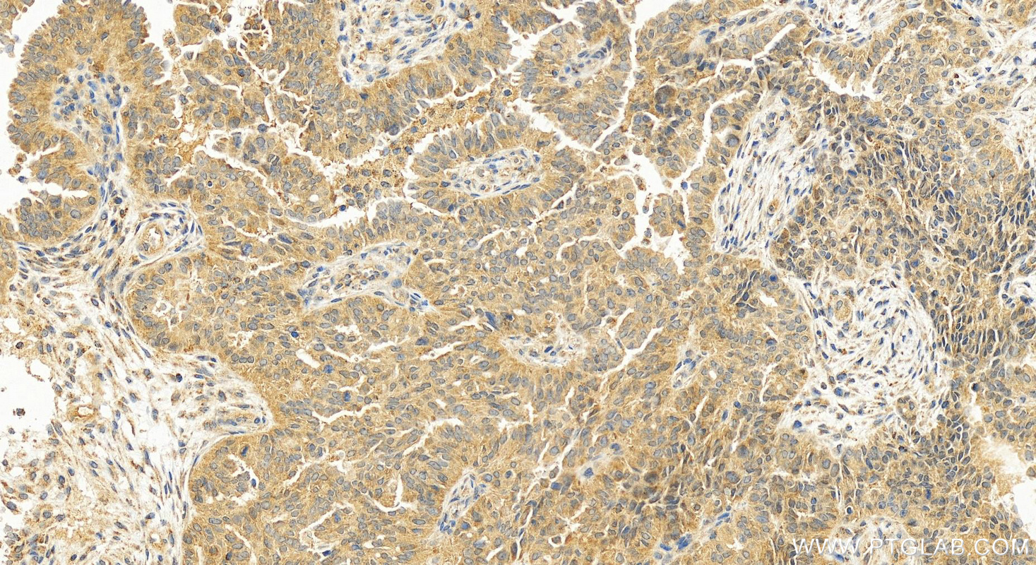 Immunohistochemical analysis of paraffin-embedded human ovarian cancer slide using 11806-1-AP (CAPZA1 antibody) at dilution of 1:200 (under 20x lens). Heat mediated antigen retrieval with Tris-EDTA buffer (pH 9.0). IHC staining of human ovarian cancer using 11806-1-AP
