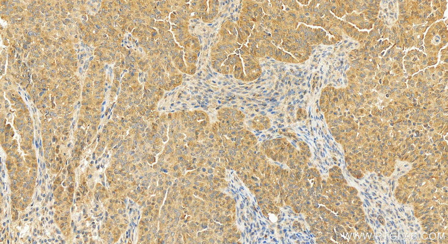 Immunohistochemical analysis of paraffin-embedded human ovarian cancer slide using 11806-1-AP (CAPZA1 antibody) at dilution of 1:200 (under 20x lens). Heat mediated antigen retrieval with Tris-EDTA buffer (pH 9.0). IHC staining of human ovarian cancer using 11806-1-AP