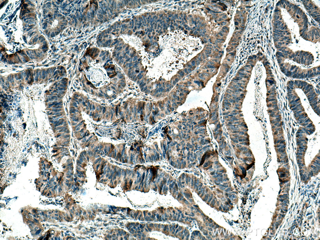 IHC staining of human colon cancer using 21741-1-AP