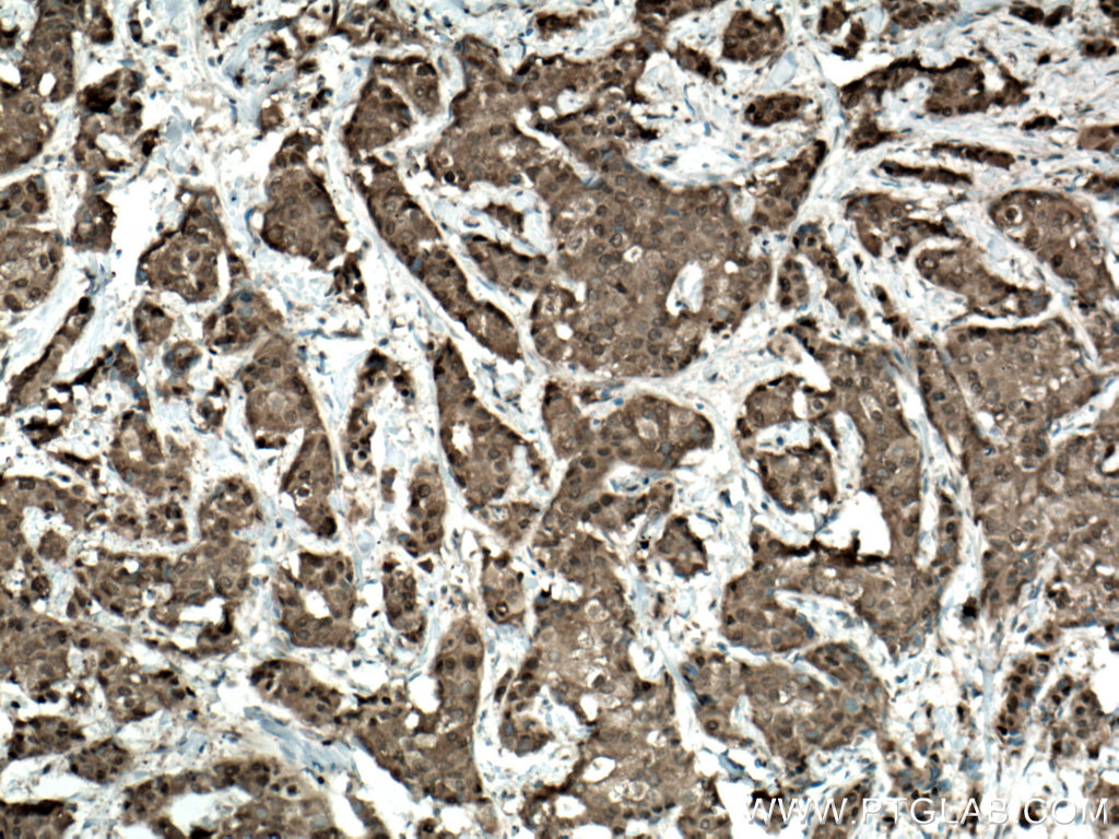 IHC staining of human breast cancer using 55246-1-AP