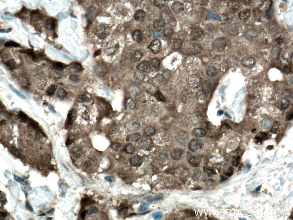 IHC staining of human breast cancer using 55246-1-AP