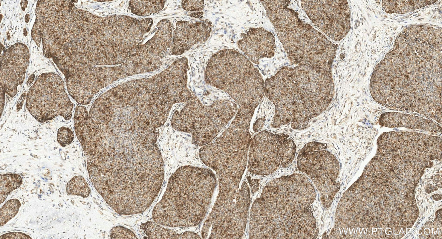 IHC staining of human breast cancer using 85146-3-RR (same clone as 85146-3-PBS)
