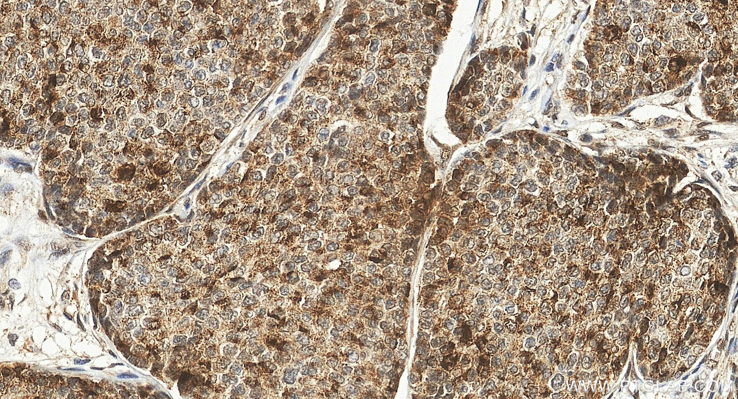 IHC staining of human breast cancer using 85146-3-RR (same clone as 85146-3-PBS)