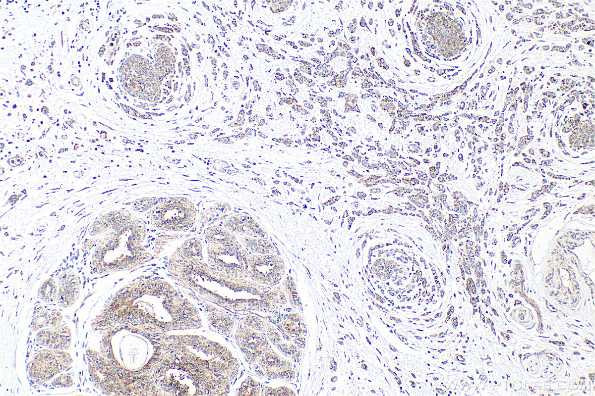 Immunohistochemical analysis of paraffin-embedded human breast cancer tissue slide using 34104-1-AP (CASD1 antibody) at dilution of 1:100 (under 10x lens). Heat mediated antigen retrieval with Tris-EDTA buffer (pH 9.0). IHC staining of human breast cancer using 34104-1-AP