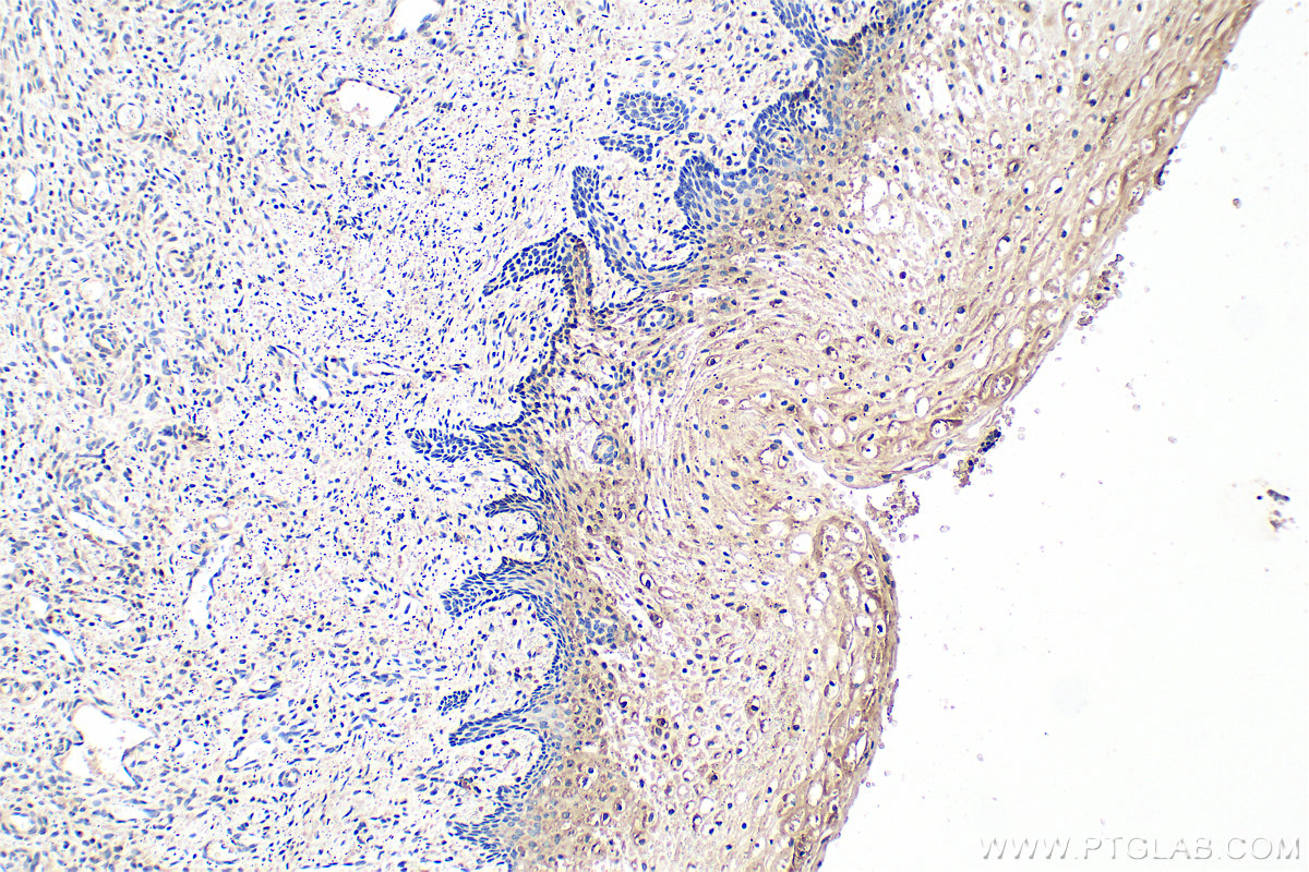 Immunohistochemical analysis of paraffin-embedded human cervical cancer tissue slide using 34104-1-AP (CASD1 antibody) at dilution of 1:100 (under 10x lens). Heat mediated antigen retrieval with Tris-EDTA buffer (pH 9.0). IHC staining of human cervical cancer using 34104-1-AP