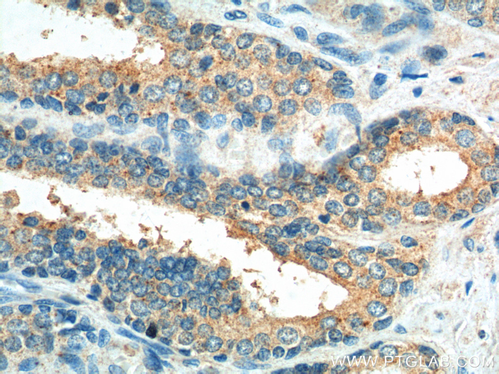 IHC staining of human prostate hyperplasia using 55238-1-AP