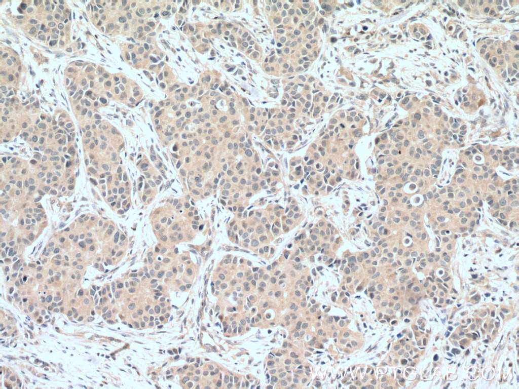 IHC staining of human breast cancer using 66470-1-Ig