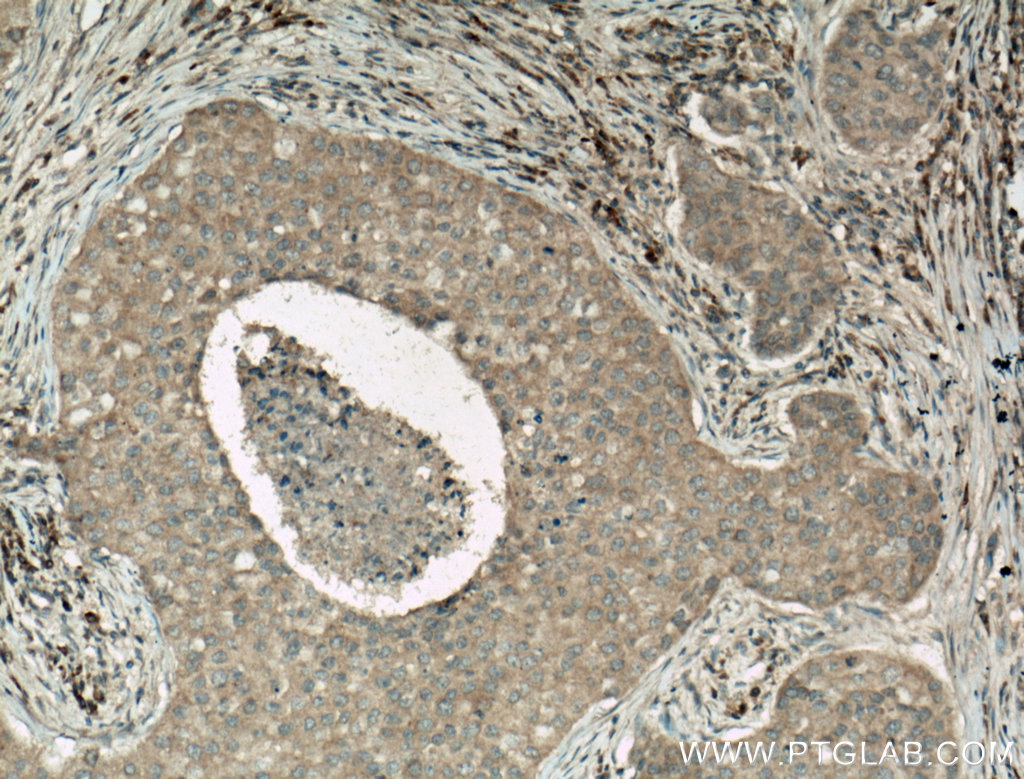 IHC staining of human breast cancer using 66470-2-Ig (same clone as 66470-2-PBS)