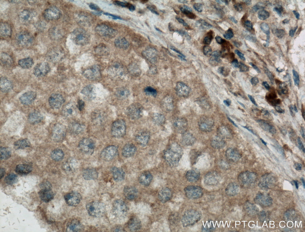 IHC staining of human breast cancer using 66470-2-Ig (same clone as 66470-2-PBS)