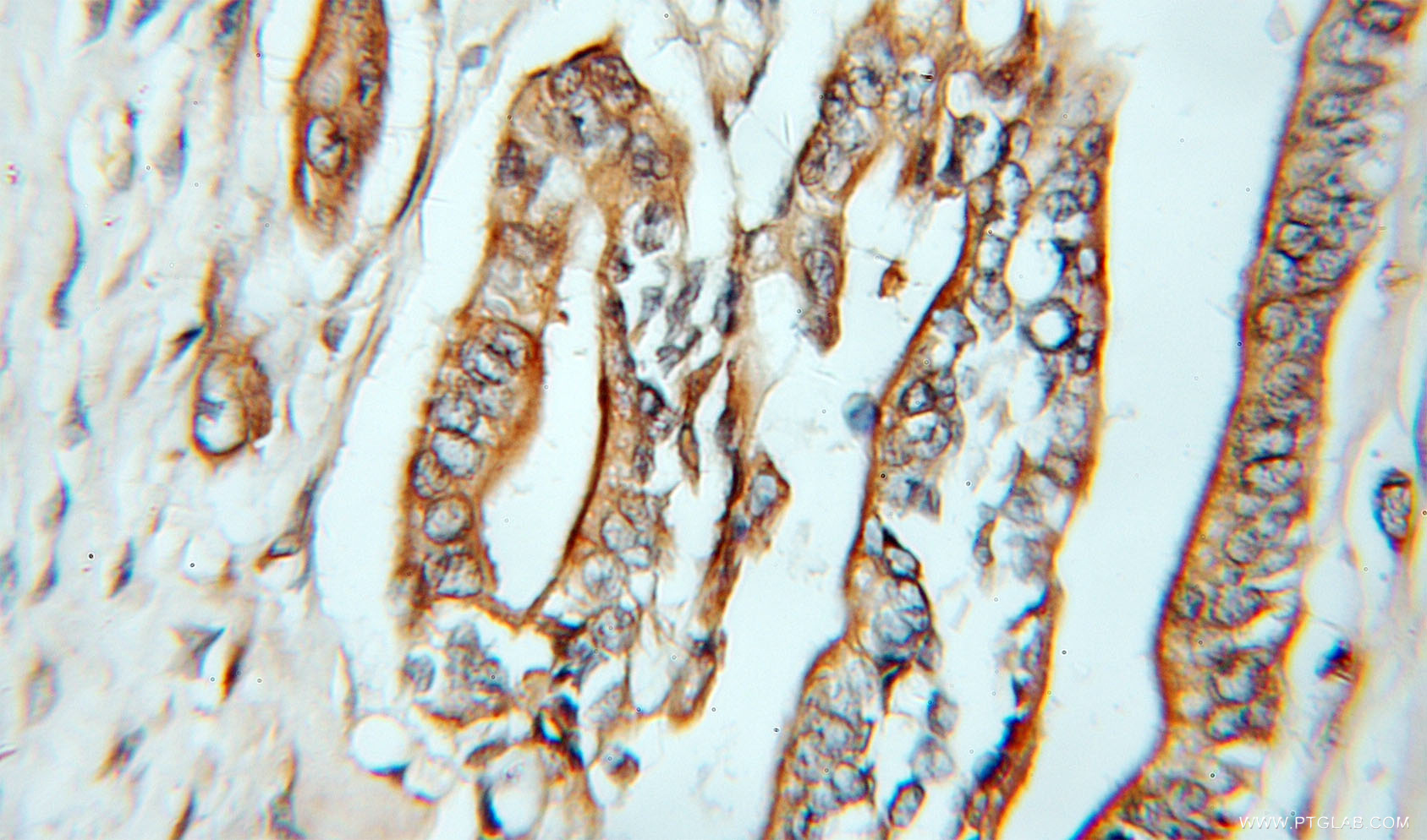 IHC staining of human pancreas cancer using 11856-1-AP