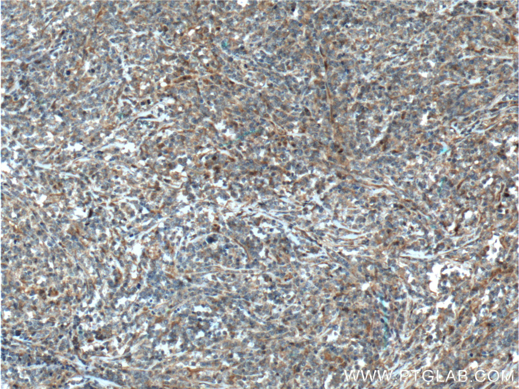 IHC staining of human lymphoma using 13423-1-AP