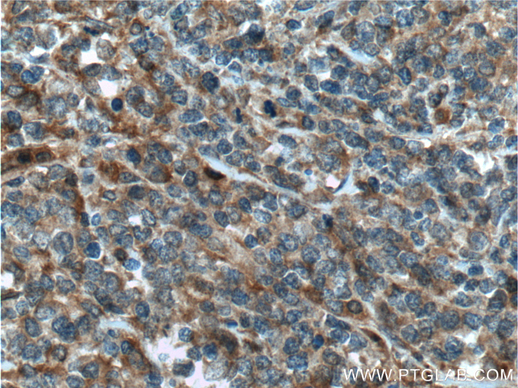 IHC staining of human lymphoma using 13423-1-AP