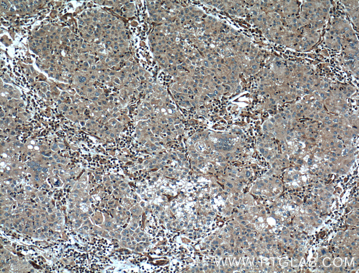 IHC staining of human liver cancer using 66093-1-Ig