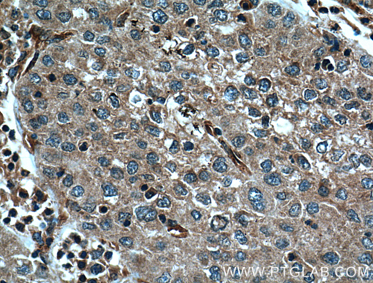 IHC staining of human liver cancer using 66093-1-Ig