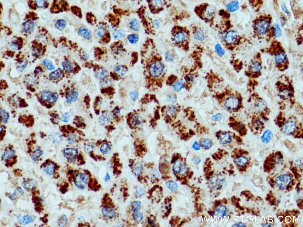 IHC staining of human liver cancer using 21260-1-AP