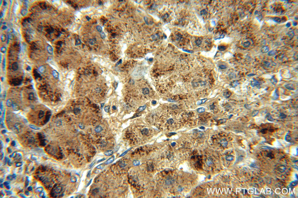 IHC staining of human hepatocirrhosis using 19792-1-AP