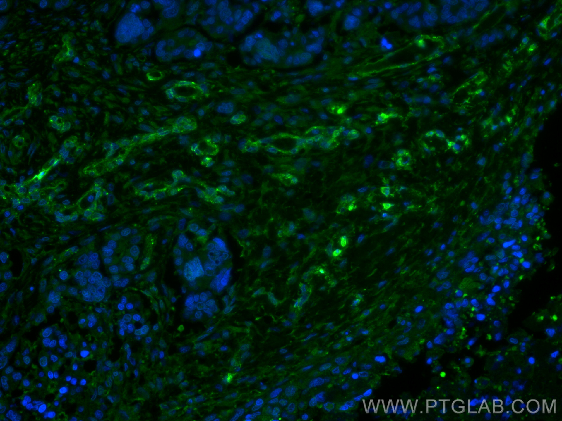 IF Staining of human liver cancer using 66067-1-Ig (same clone as 66067-1-PBS)