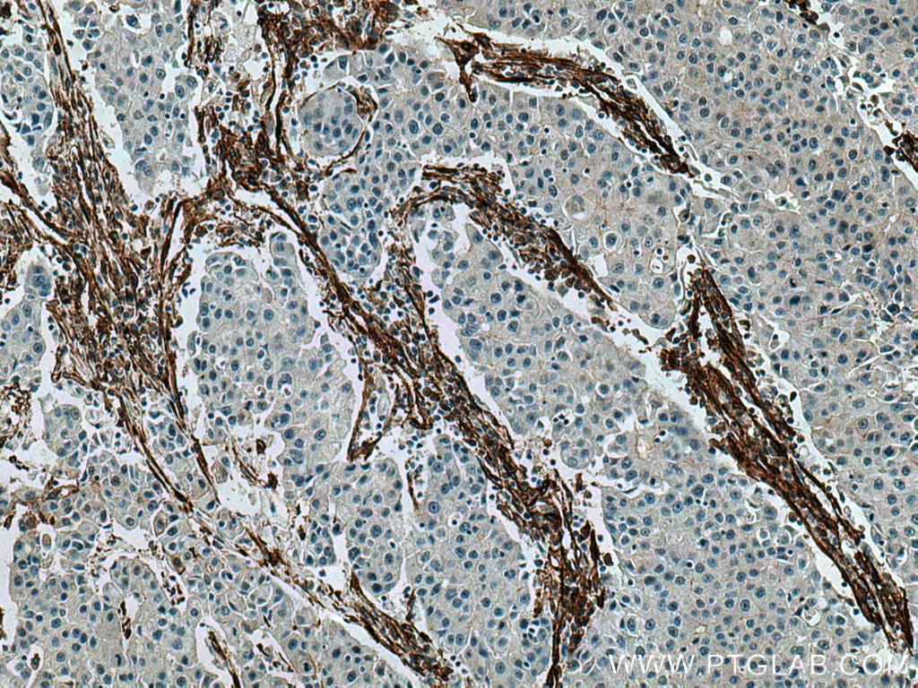 IHC staining of human breast cancer using 66067-1-Ig (same clone as 66067-1-PBS)