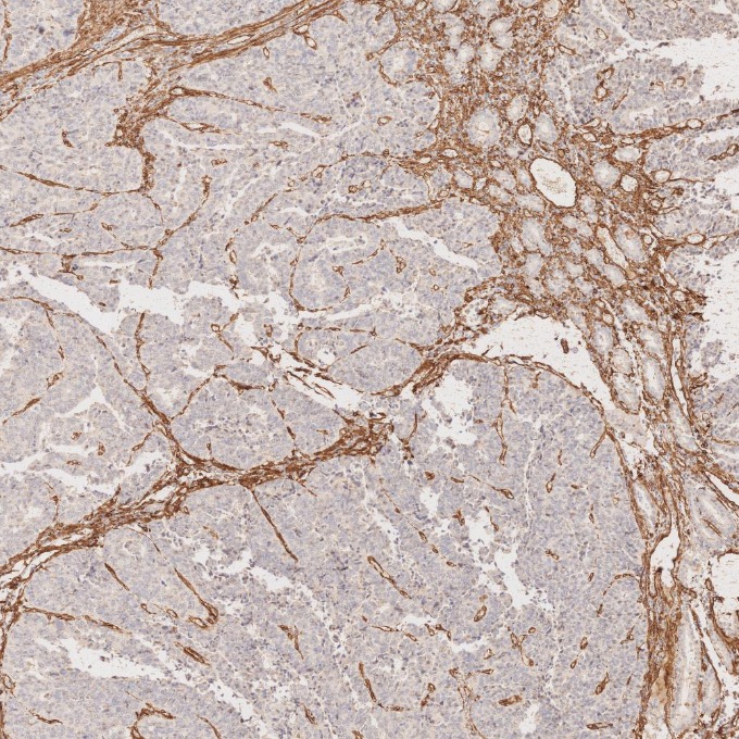 IHC staining of human stomach cancer using 66067-1-Ig
