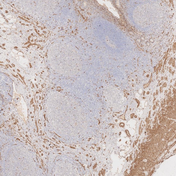 IHC staining of human appendicitis using 66067-1-Ig