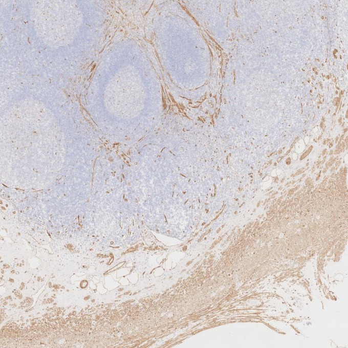 IHC staining of human appendicitis using 66067-1-Ig