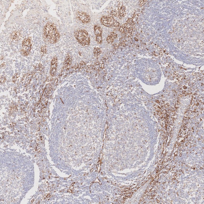 IHC staining of human tonsillitis using 66067-1-Ig