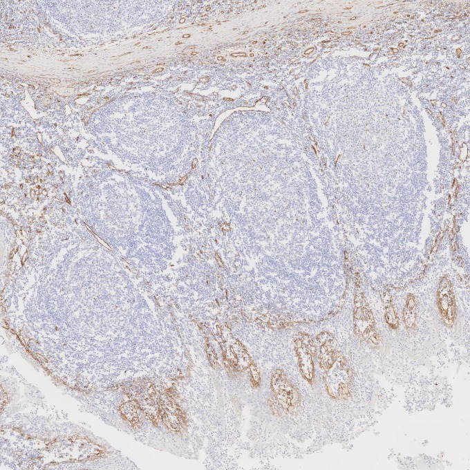 IHC staining of human tonsillitis using 66067-1-Ig