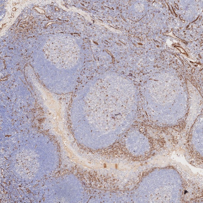 IHC staining of human tonsillitis using 66067-1-Ig