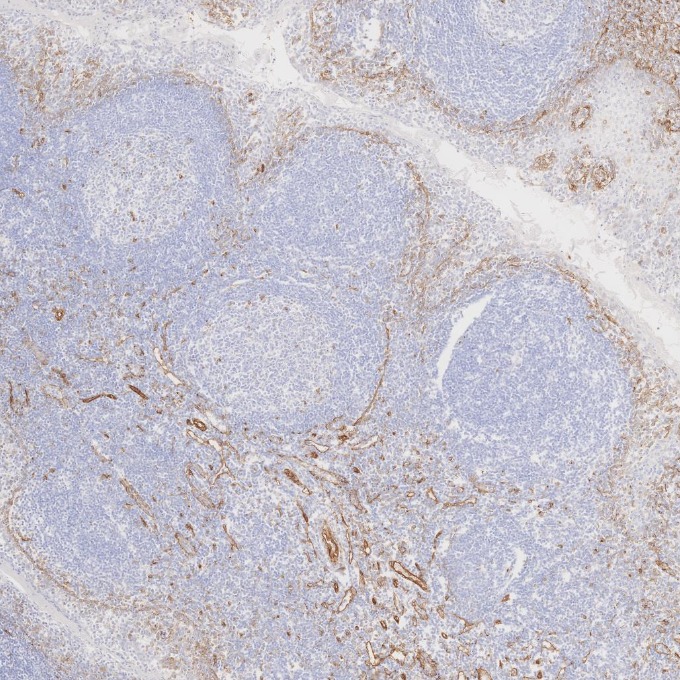 IHC staining of human tonsillitis using 66067-1-Ig