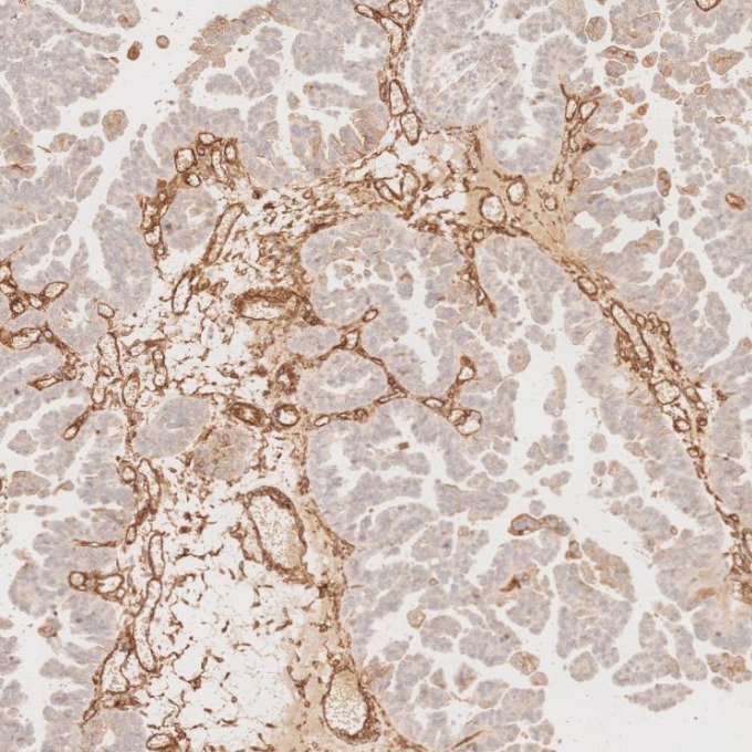 IHC staining of human ovary cancer using 66067-1-Ig