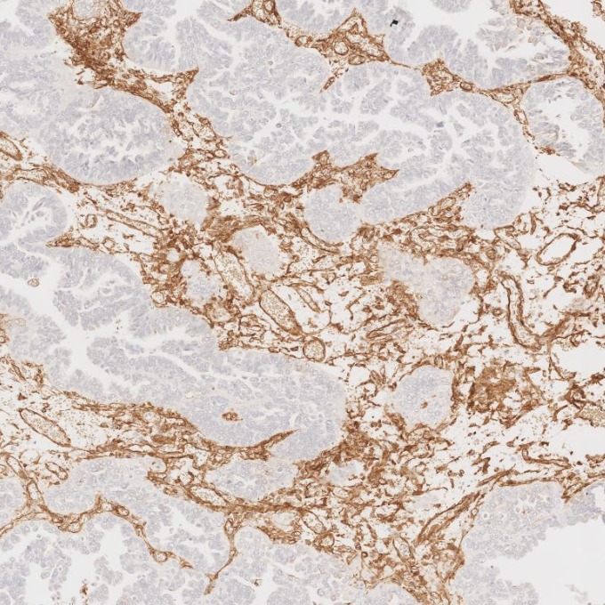 IHC staining of human ovary cancer using 66067-1-Ig