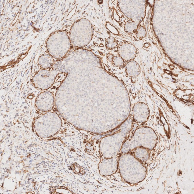 IHC staining of human breast cancer using 66067-1-Ig