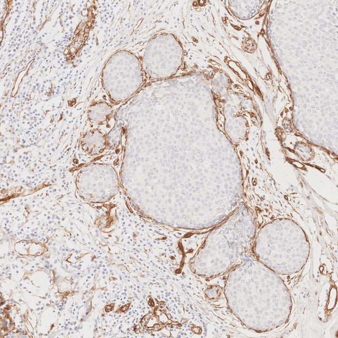 IHC staining of human breast cancer using 66067-1-Ig