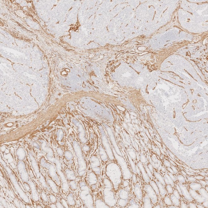 IHC staining of human stomach cancer using 66067-1-Ig