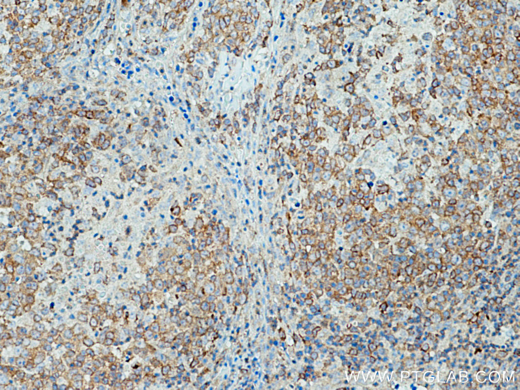 IHC staining of human lymphoma using 25818-1-AP