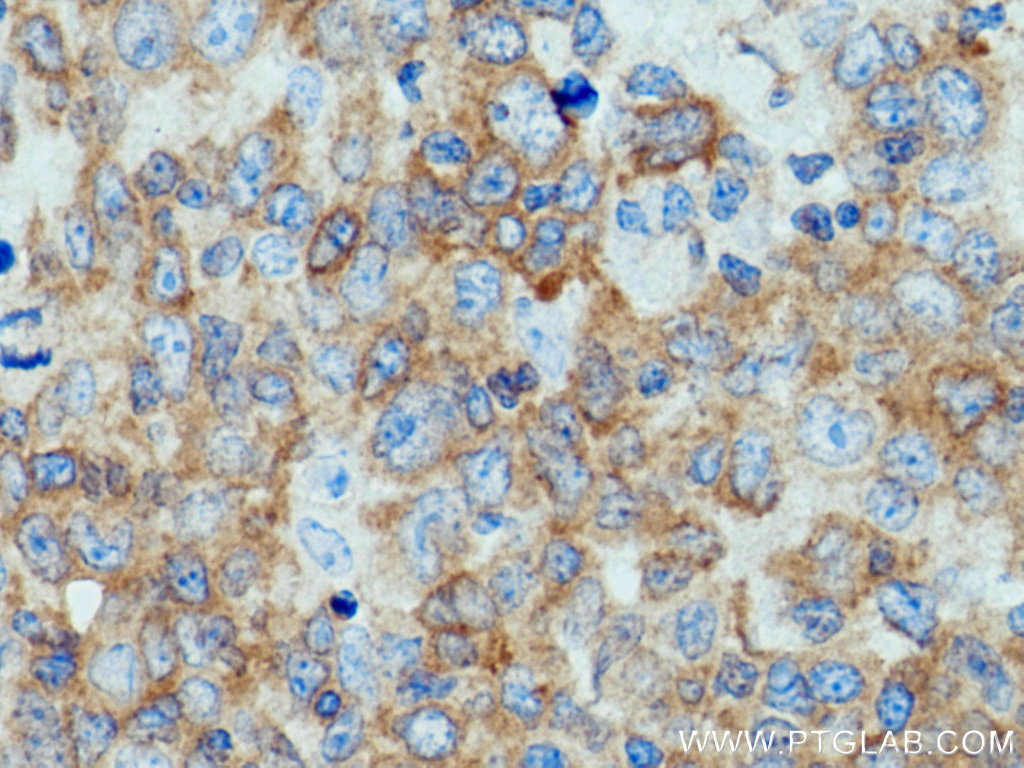 IHC staining of human lymphoma using 25818-1-AP