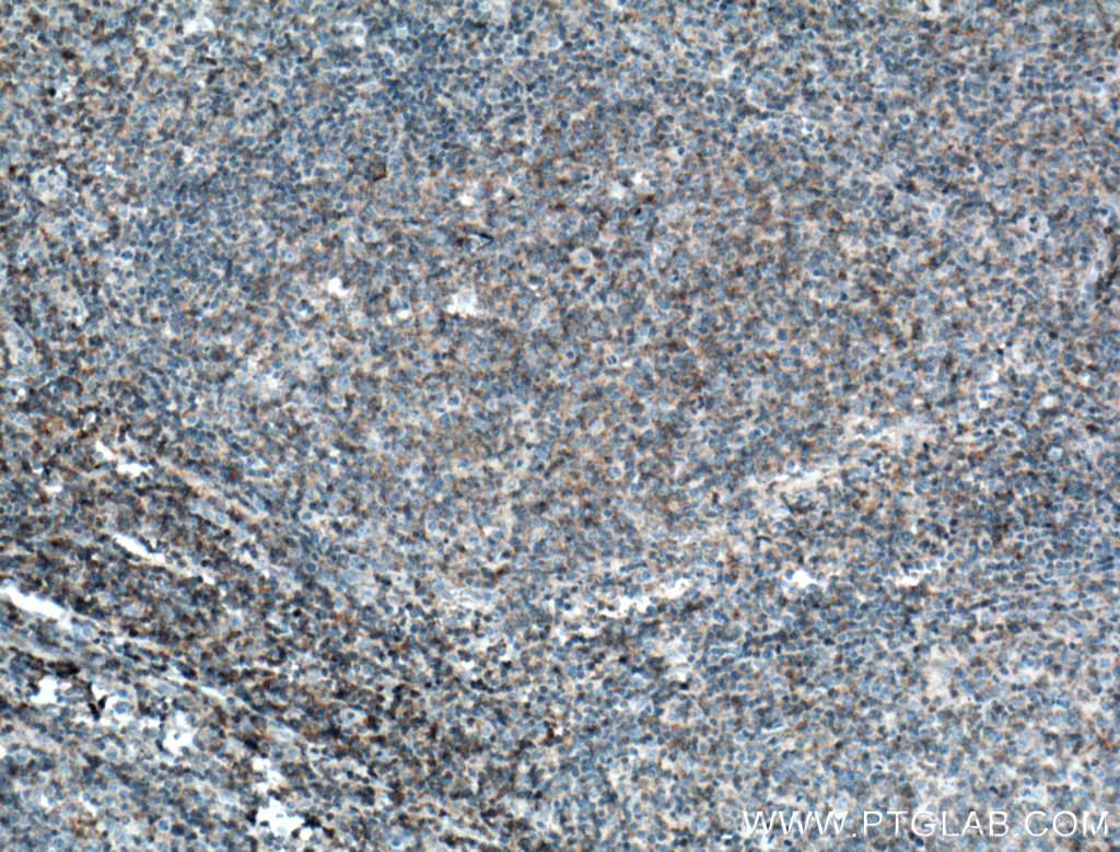 IHC staining of human tonsillitis using 66576-1-Ig (same clone as 66576-1-PBS)